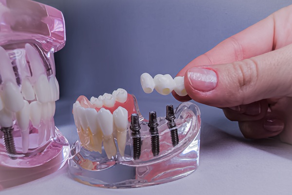 Dental Bridge Options: How Bridges Replace Missing Teeth And Support Bite Function