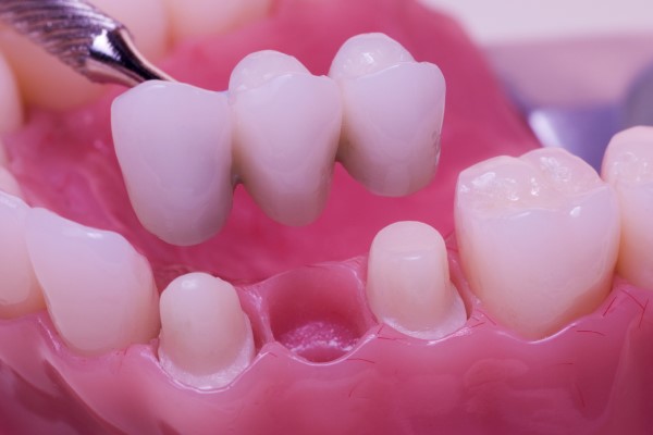 Can Dental Bridges Be Removable?