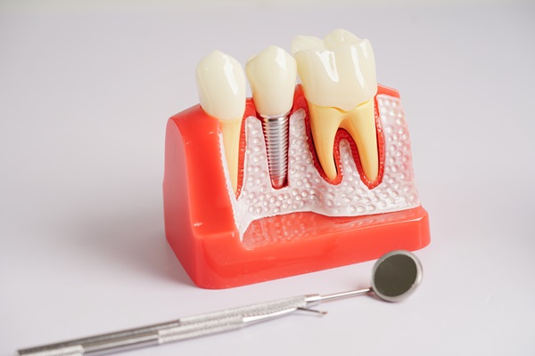 Benefits Of Dental Implants