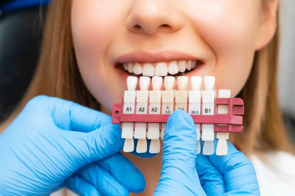 Ways To Prepare For Dental Veneers