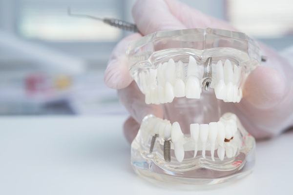 Are Implant Supported Dentures Possible With A Single Procedure?